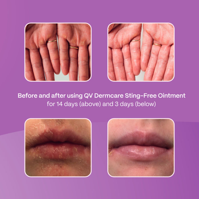 QV Intensive Sting-Free Ointment 100g - image 3